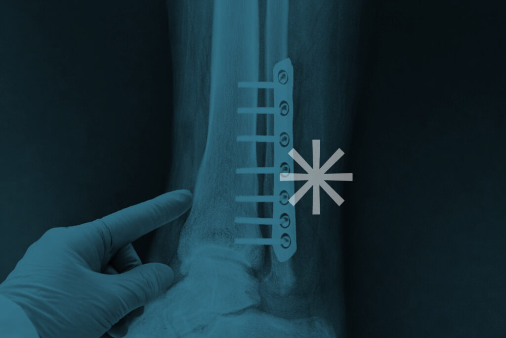 Odstranění osteosyntetického materiálu po operaci