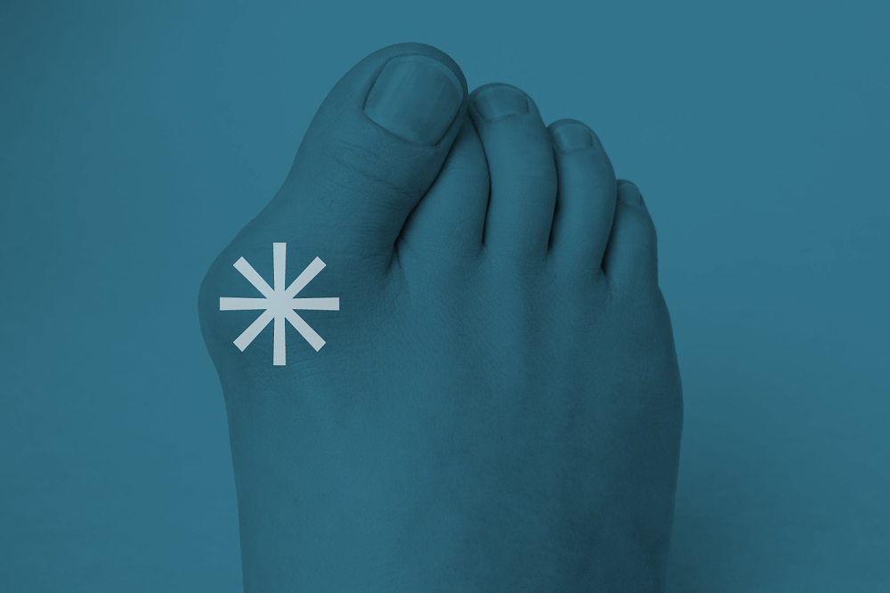 Vbočený palec – známý také jako hallux valgus